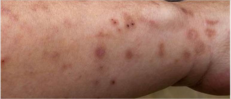 Bed bug bites scars